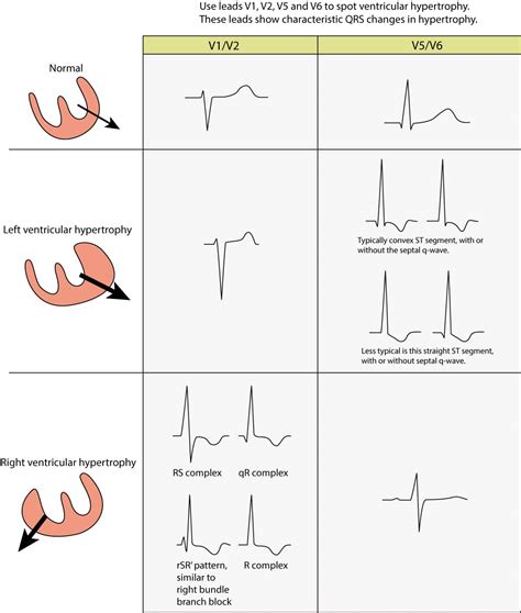 lv ecg|ecg lvh meaning.